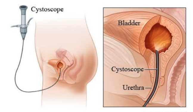 Bladder Cancer and Blood Clots (Thromboembolism)