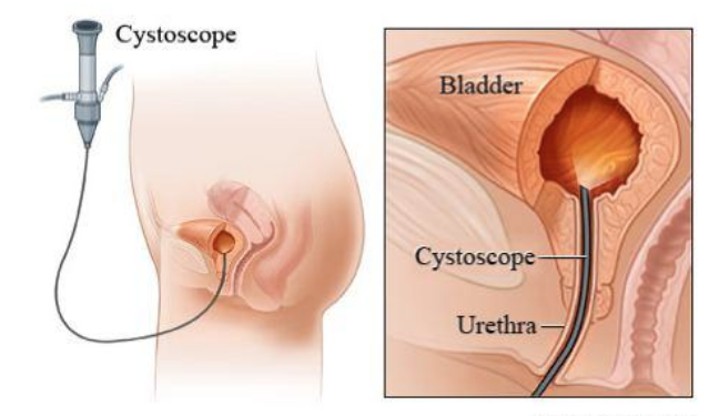 Cystoscopy with Bladder Biopsy